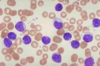 慢性粒细胞白血病的最主要临床表现是 - 图片专