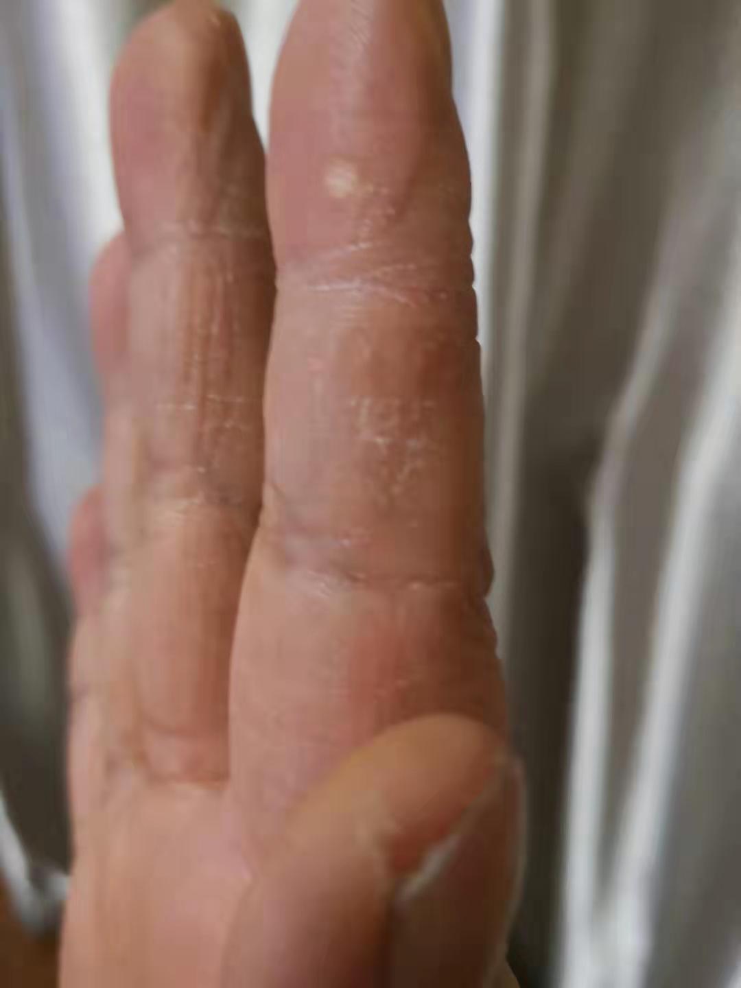 一天洗手二十多次,社区工作者的手开始皴裂