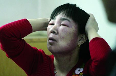 郑大五附院诊断脸部浮肿的翟女士是化妆品过敏