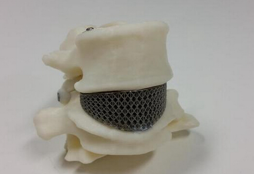 澳大利亚:首例3D打印钛金属脊柱植入手术