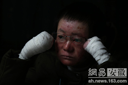 "蝴蝶男孩":5成皮肤没表皮 全身裹得像木乃伊