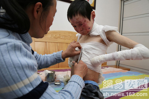 "蝴蝶男孩":5成皮肤没表皮 全身裹得像木乃伊