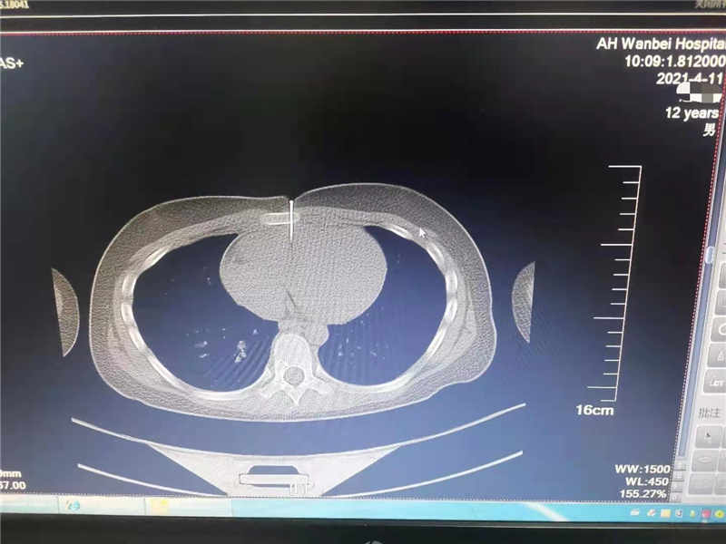 12岁男童玩气钉枪"走火" 4cm钉子射入心脏