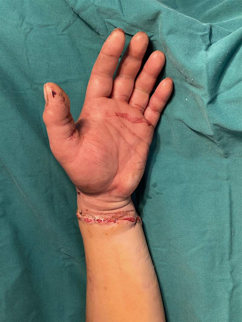 安庆一男子手臂被钢刀截断 5名医生10小时接力为其接回