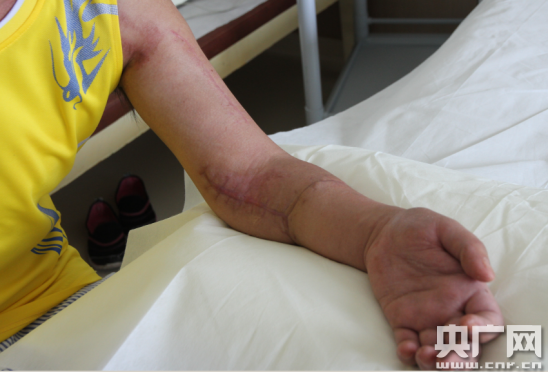 广东8名医生完成罕见断臂再植手术