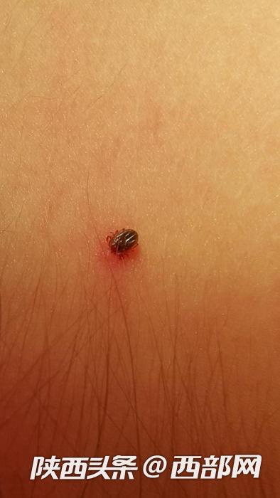 2名儿童中招局部皮肤被切除 春游踏青野餐需警惕蜱虫