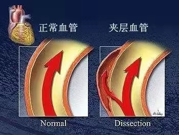 主动脉夹层示意图图片图片